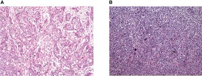 A Comprehensive Model for Diagnosis of Primary Breast Lymphoma Differentiated From Breast Cancer and Prognosis Evaluation of Surgical Treatment